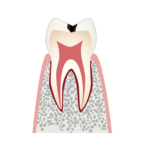 C1 エナメル質の虫歯