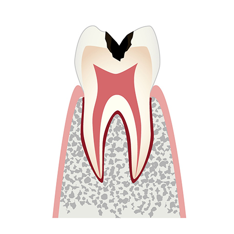 C2 象牙質の虫歯