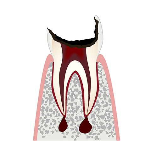 C4 歯根の虫歯