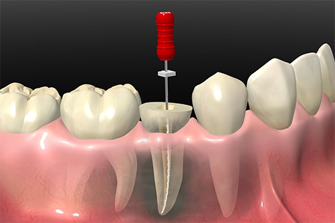 根管治療