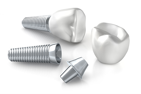 インプラント治療とは