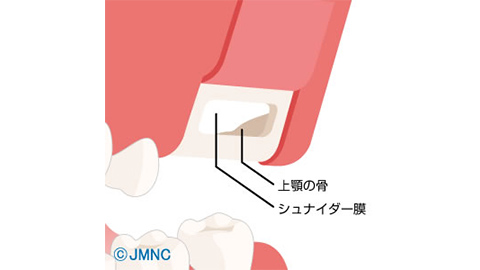 サイナスリフト