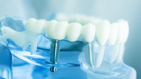 人工歯の作製・装着