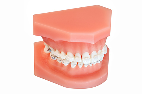 ブラケット矯正