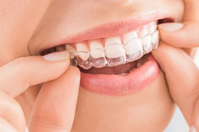 マウスピース矯正