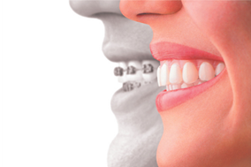 インビザラインのメリット