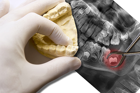 親知らずの抜歯
